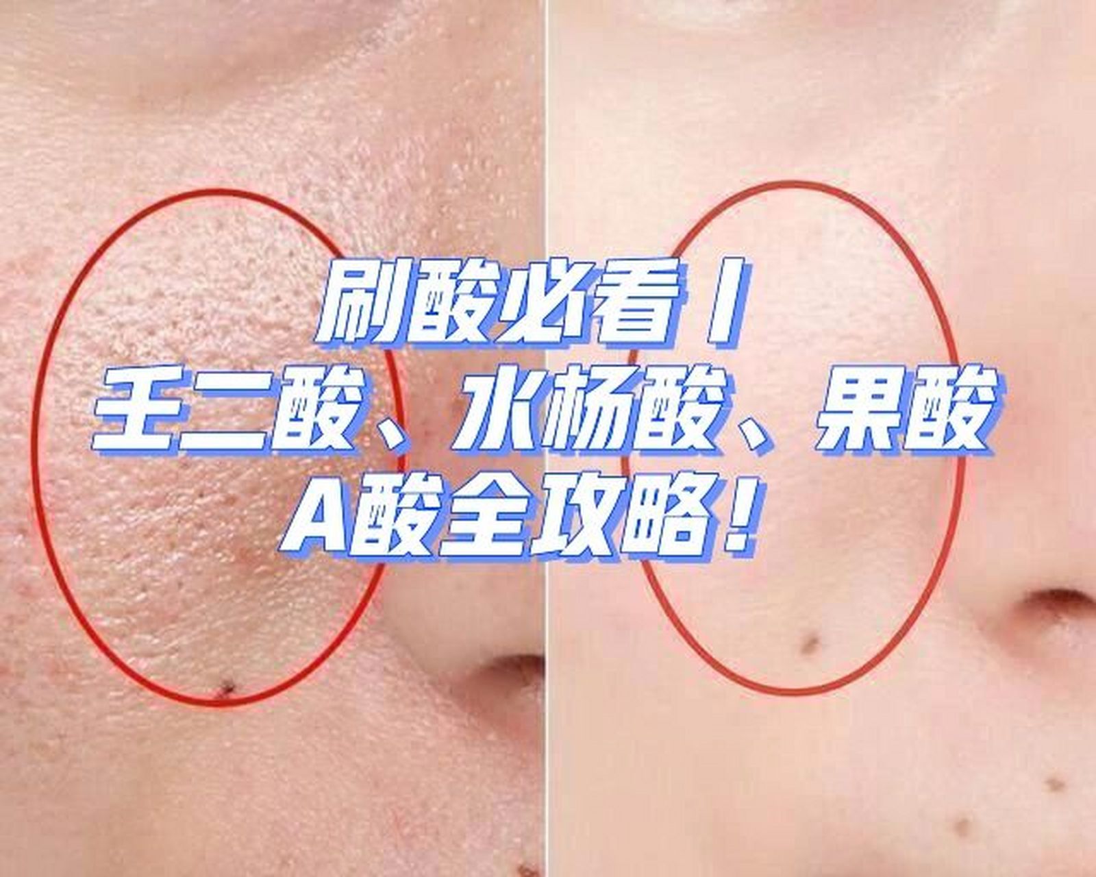 刷酸必看|壬二酸,水杨酸,果酸,a酸全攻 95 1.
