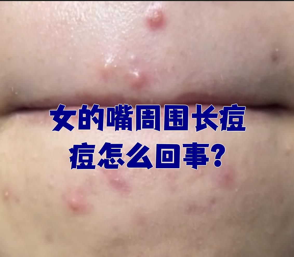 为什么嘴巴周围老是反复长痘痘,吃什么中成药?为什么在线 为什么嘴巴周围老是反复长痘痘,吃什么中成药?为什么在线