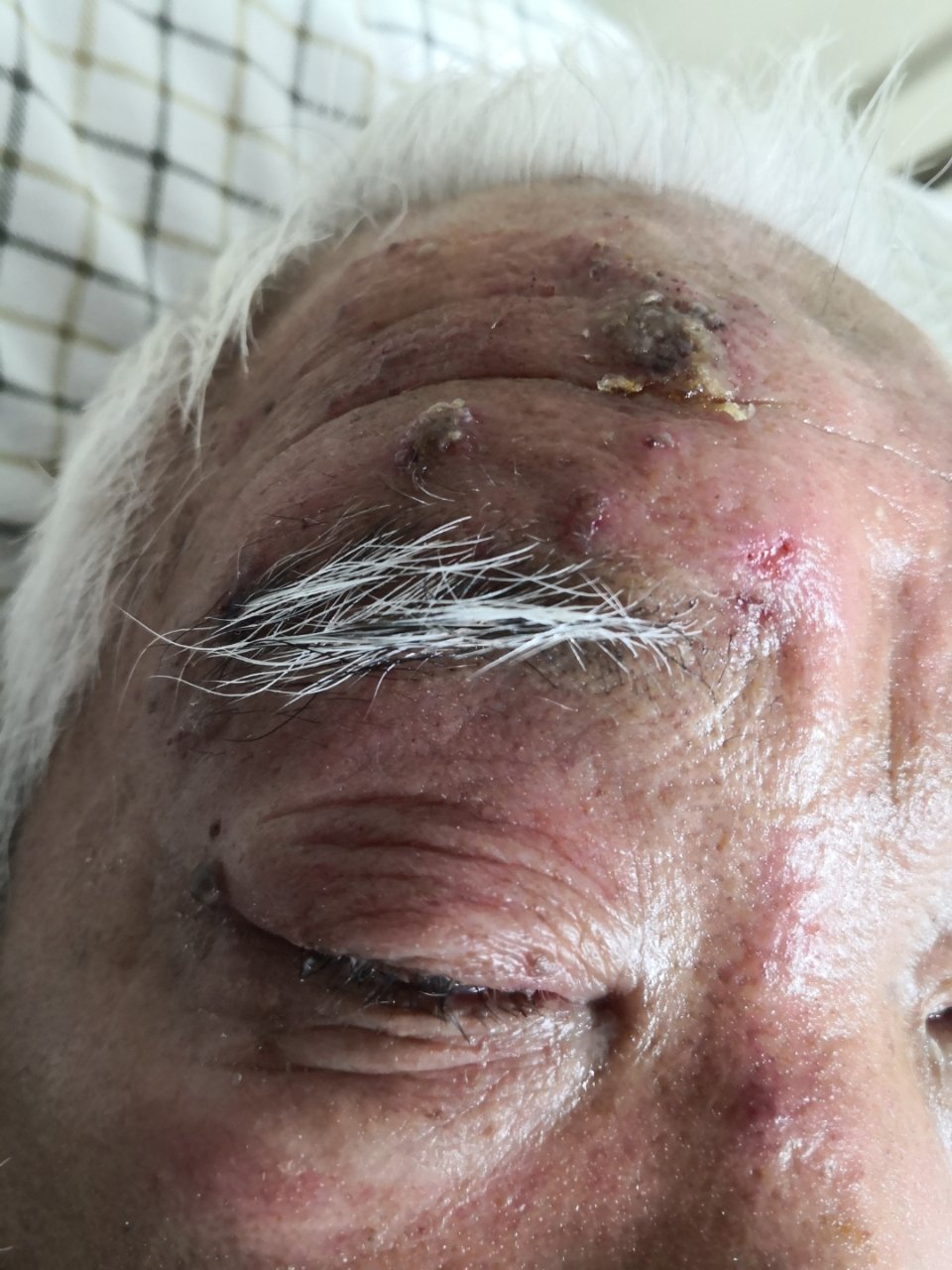 解决皮肤问题专注皮肤美容##带状疱疹