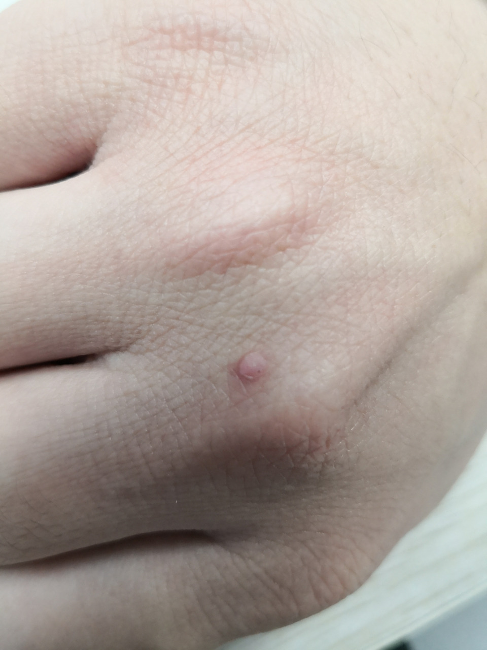 手背寻常疣.激光治疗去除可以#寻常疣