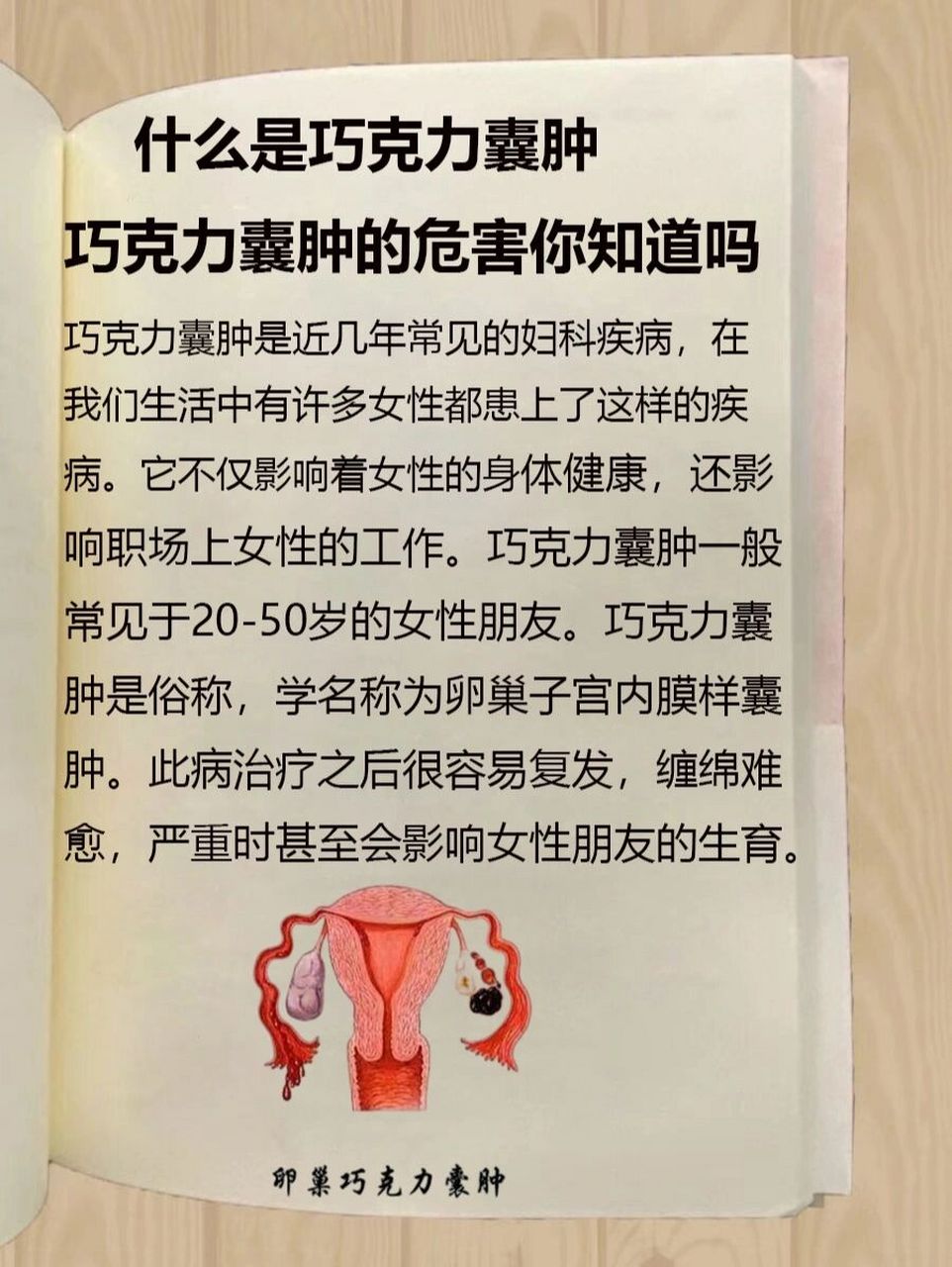 什么是巧克力囊肿巧克力囊肿危害你知道吗 96巧克力囊肿是近几年