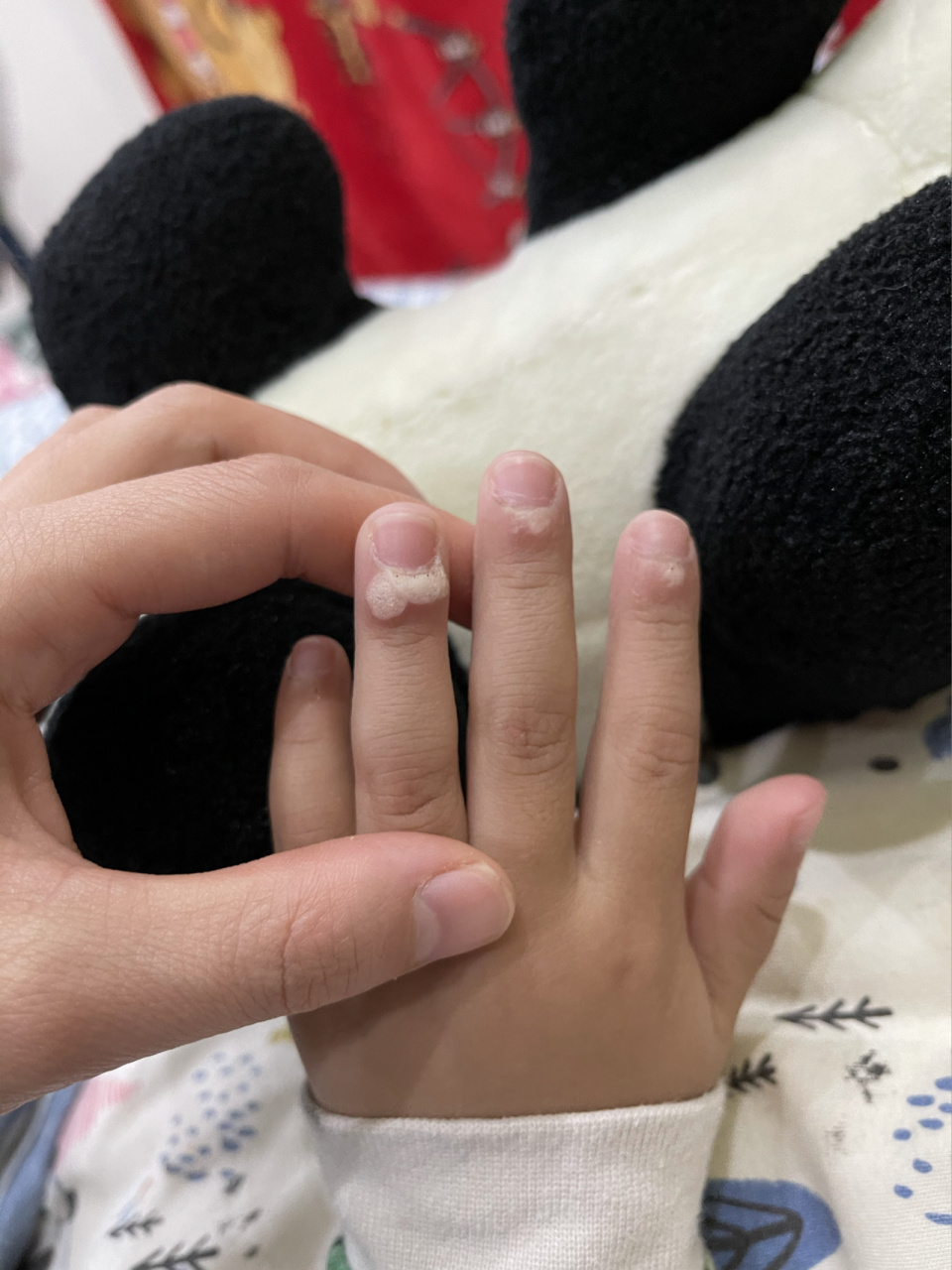 甲周疣打卡第二天05九度米醋 咪喹莫特乳膏