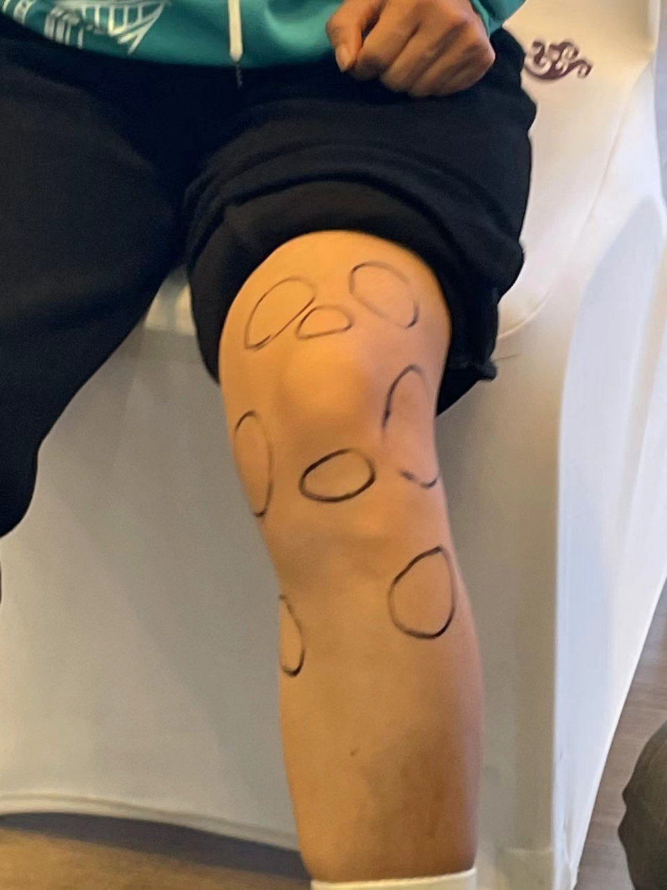 膝盖积液 拔罐穴位 刮痧77灸法77拔罐,连续做直到积液消除