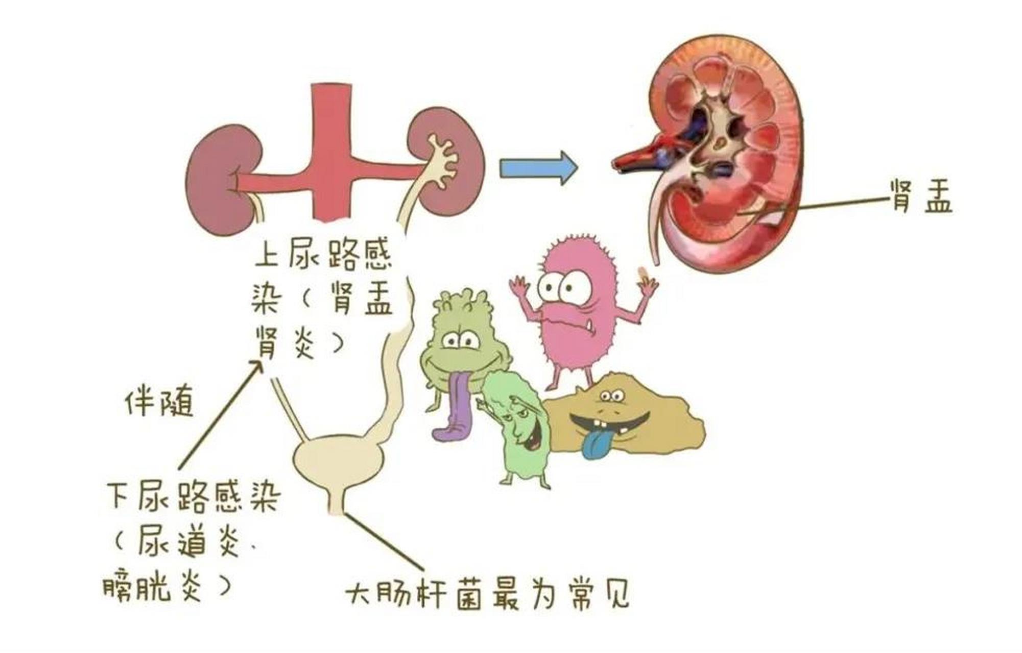 可能是泌尿系惹的祸  最近床位上收治了几位病人伴有尿路感染,感染均