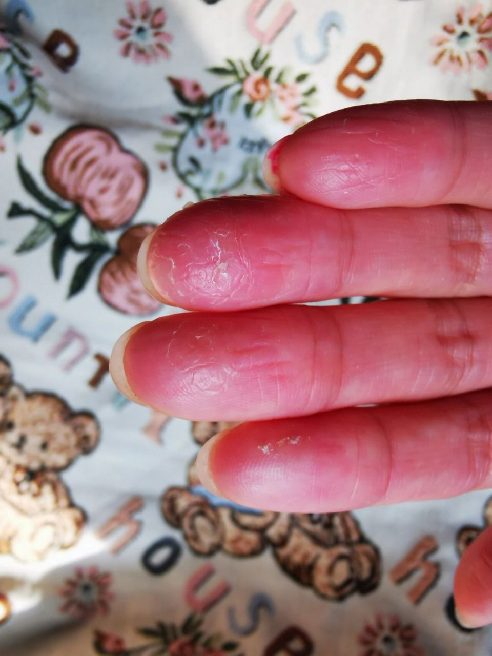 手指干裂起皮是什么原因 朋友们,知道手指干裂起皮是什么原因吗,有说