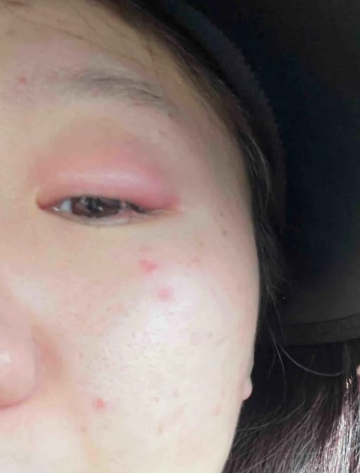 上眼皮红肿痒脱皮起皱可能是过敏或湿疹引起的