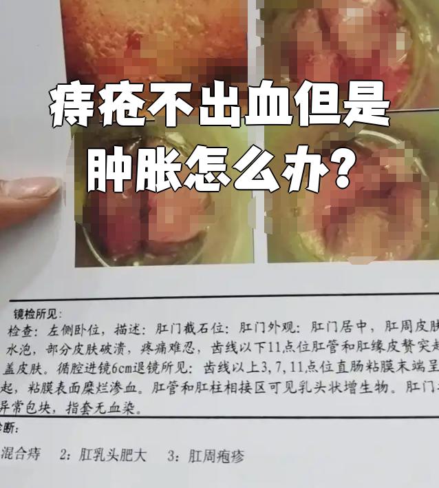 痔疮分为外痔,内痔和混合痔.早期症