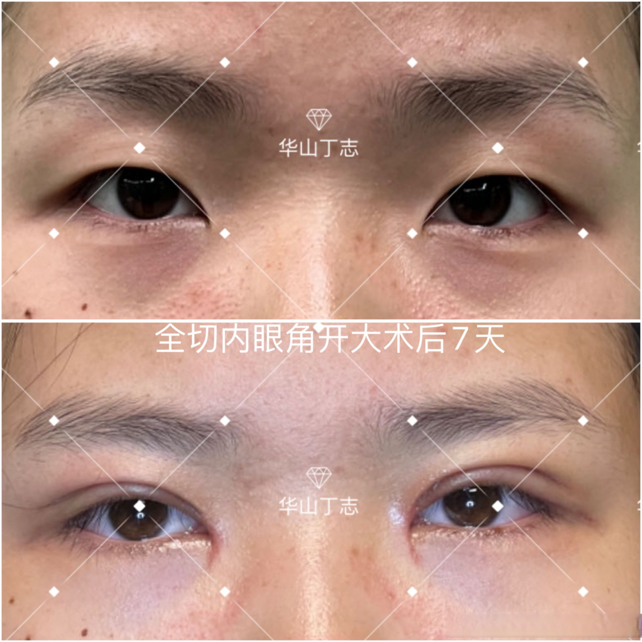 案例展示:全切双眼皮 内眼角开大,术后七天.