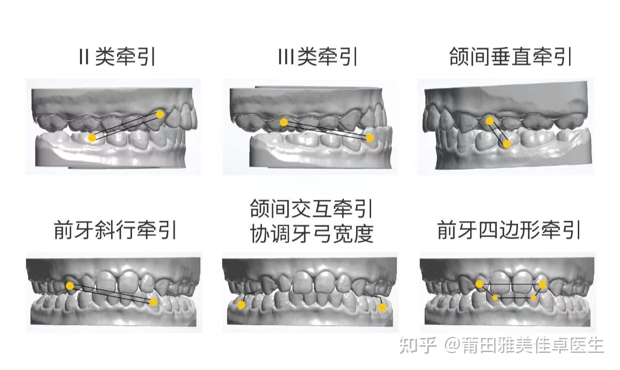 牙齿二类牵引示意图图片