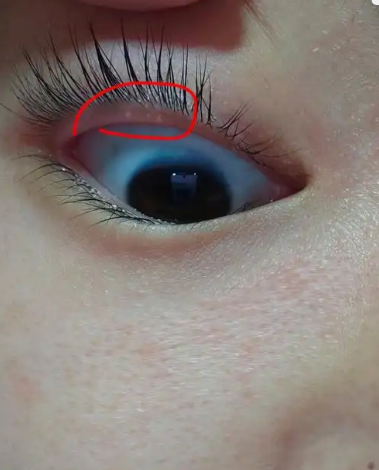 眼睑上长小水泡常见原因有这几种: