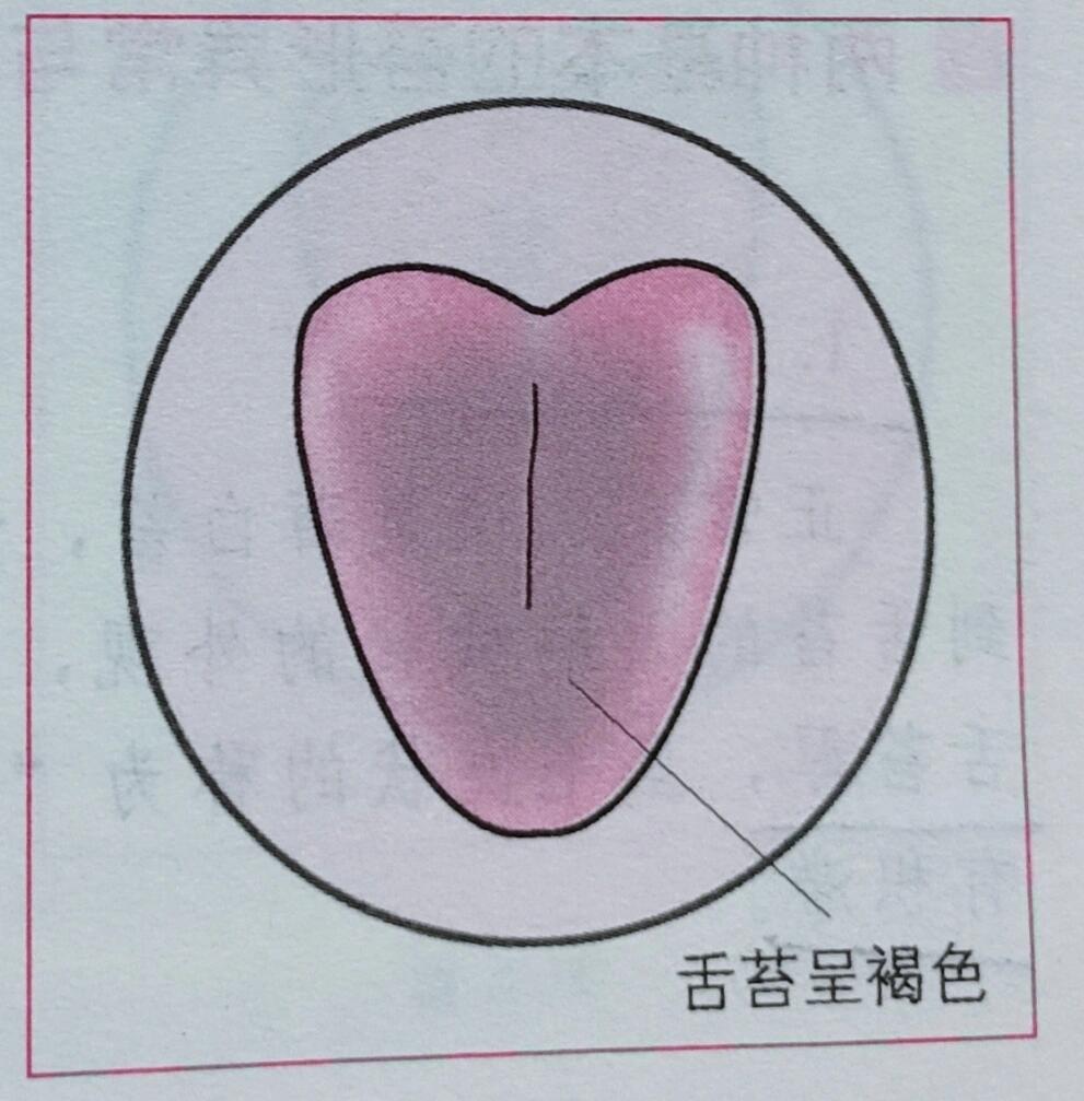 9899舌苔色黑和褐色