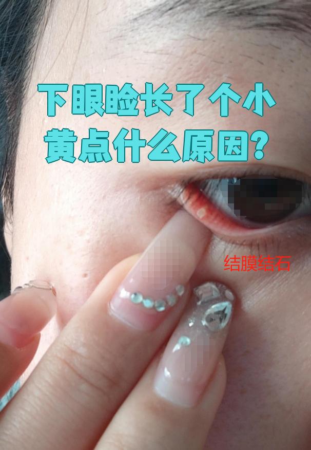 下眼睑长小黄点可能和脂肪粒,麦粒肿,霰粒肿,结膜结石,汗腺瘤等情况