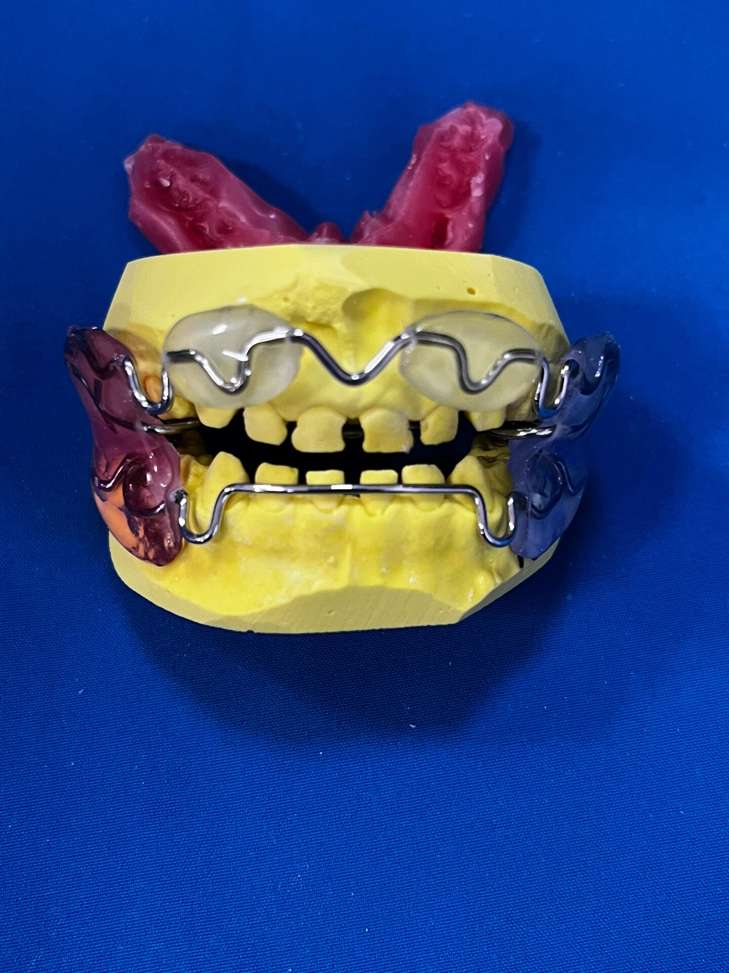 儿童早期反颌矫正——法兰克3 儿童的牙齿畸形要引起家长们的关注