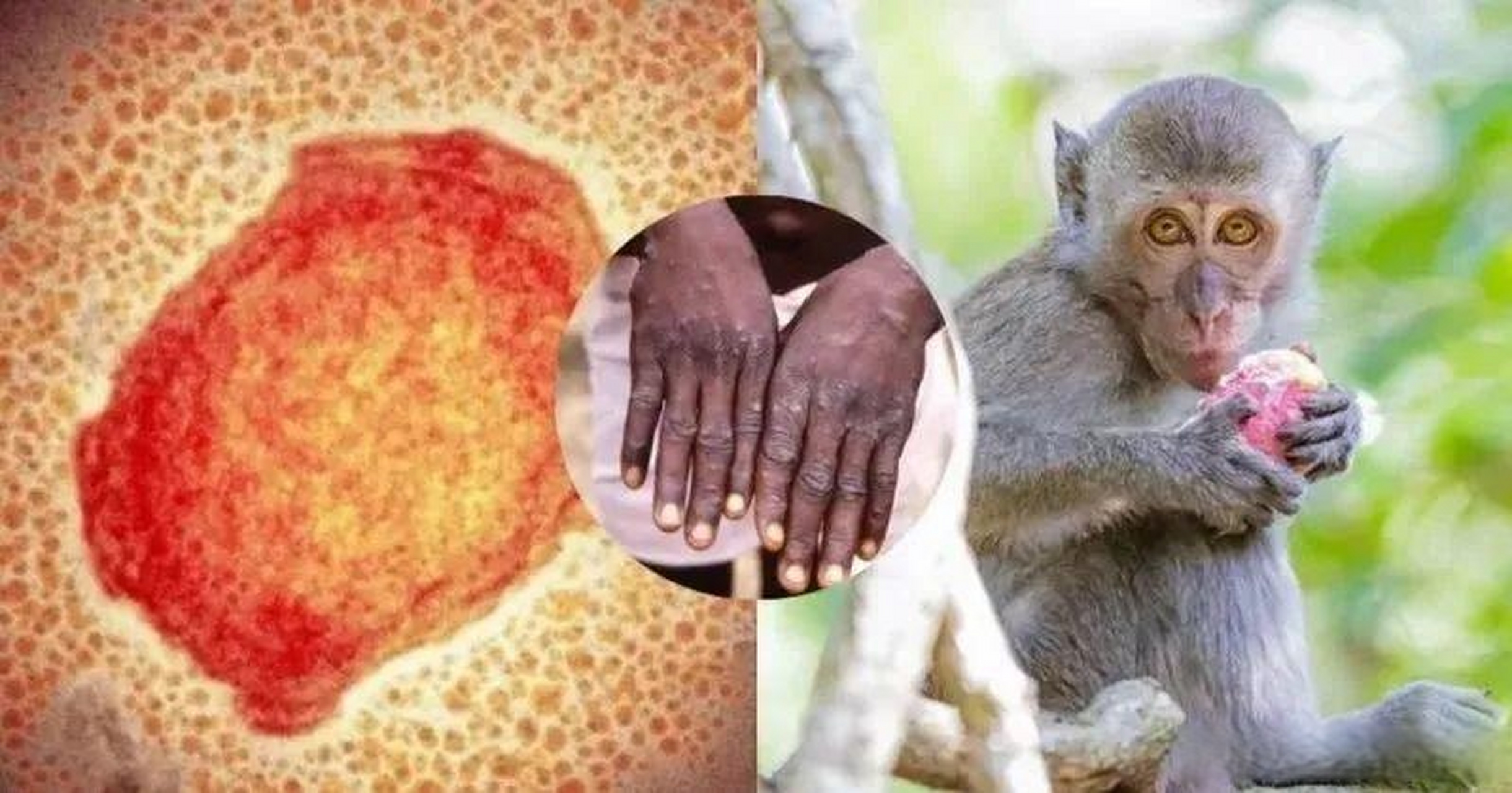湖北猴痘# 【感染猴痘病毒有哪些症状】近期,全国多地接连监测发现