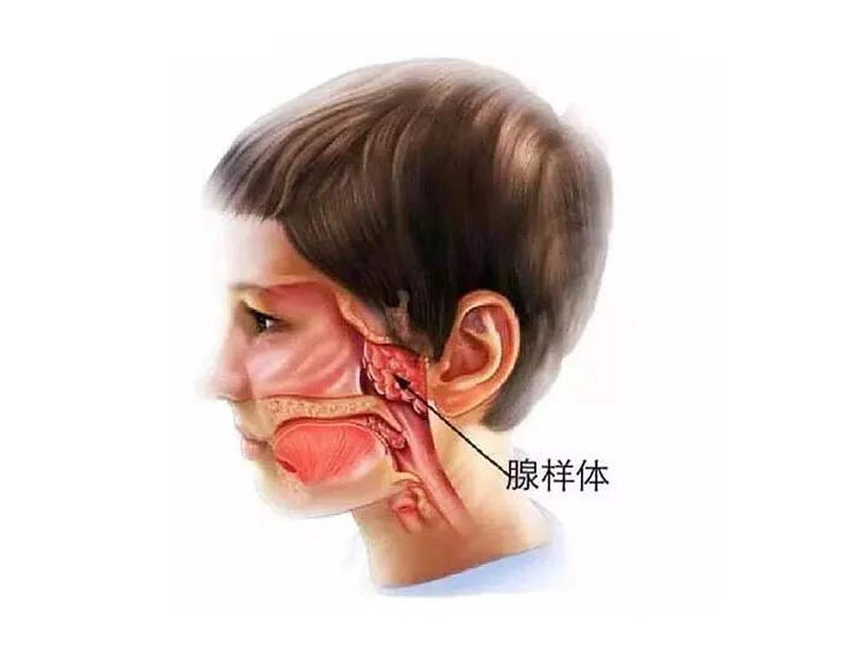 越来越多孩子有腺样体肥大,原因是什么?