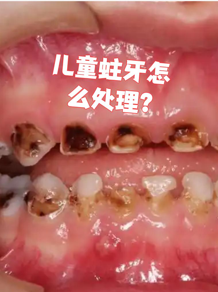 这时候如果孩子不好好刷牙,食物残渣留在牙齿上,细菌就会破坏牙釉质