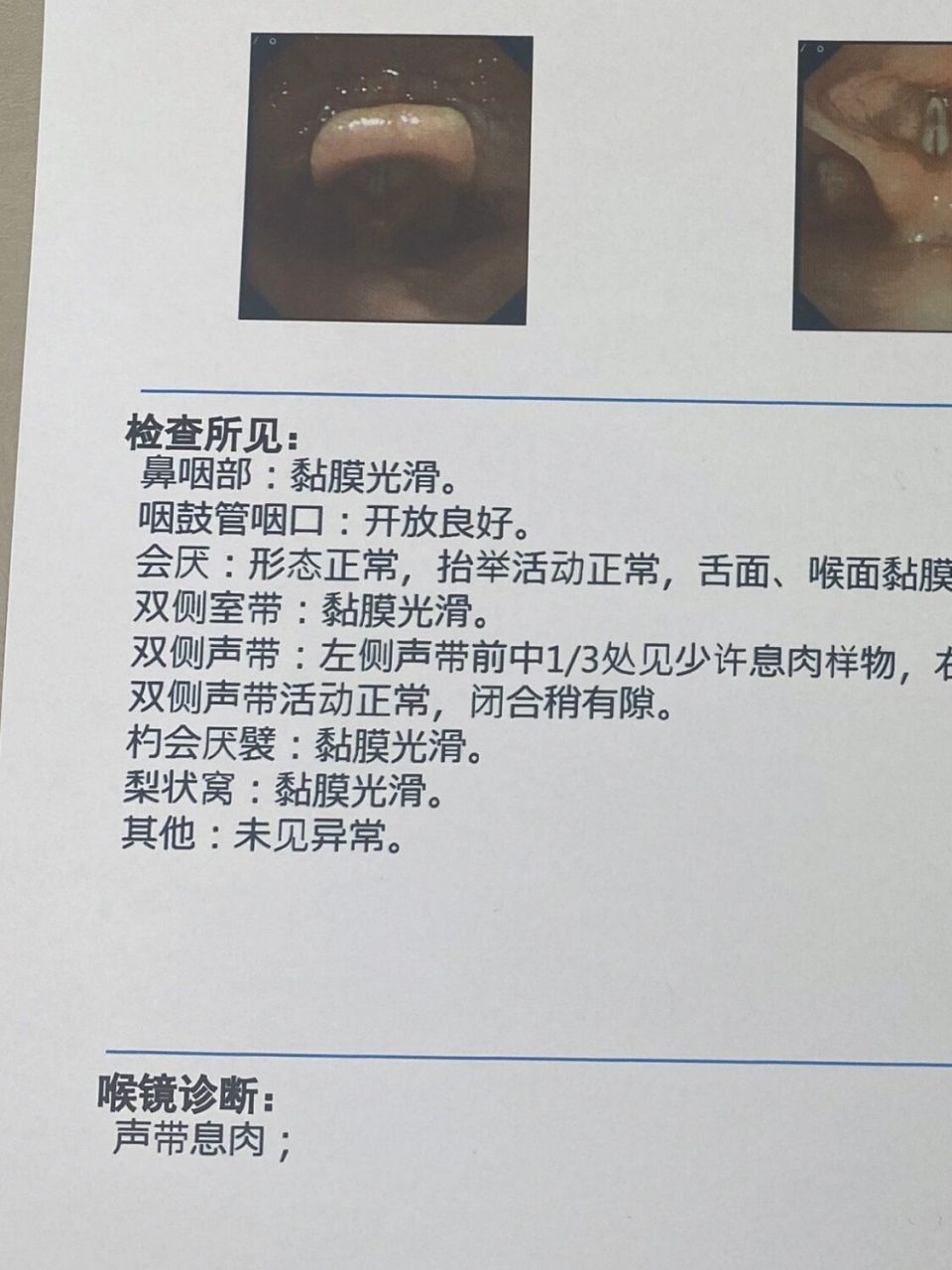 刘亦菲们,职业病得了声带息肉,医生说要做手术,有必要吗