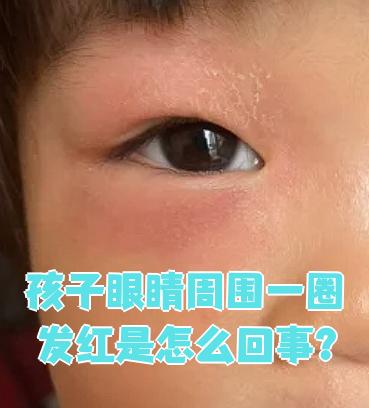 孩子眼睛周围发红可能由多种原因引起,比如高热,环境因素,面部湿疹
