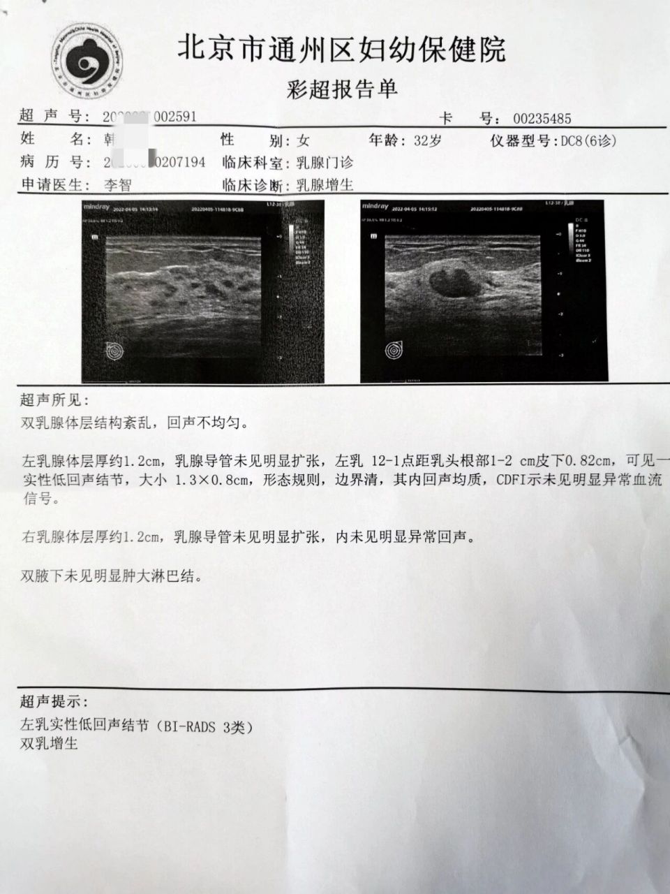 乳腺增生报告图片