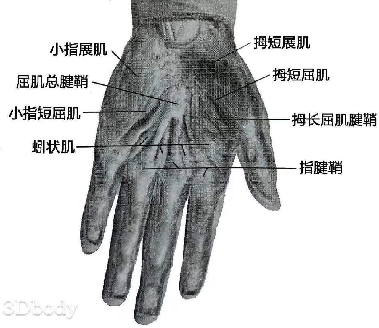 屈指肌腱腱鞘炎图片