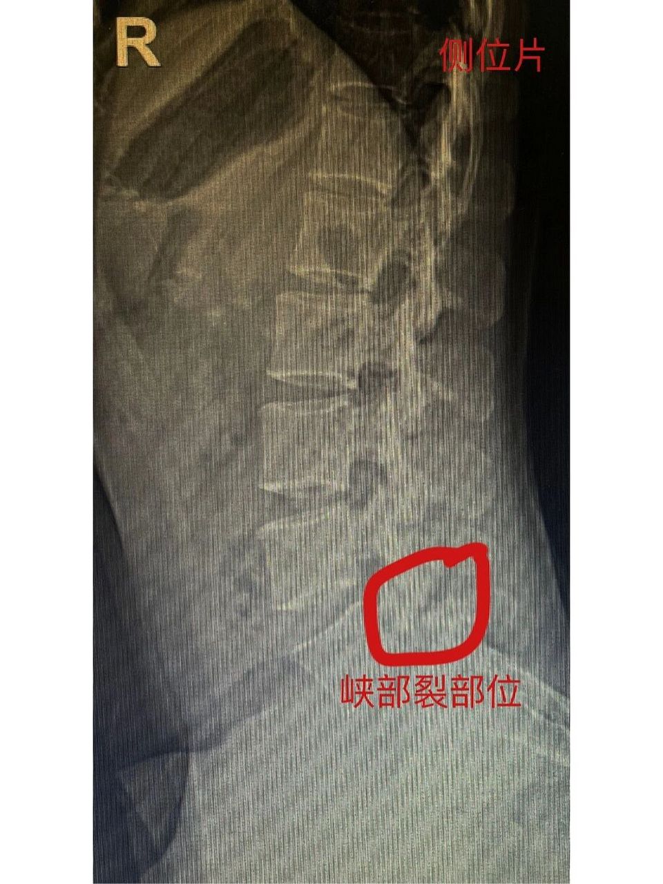 脊柱裂核磁图片