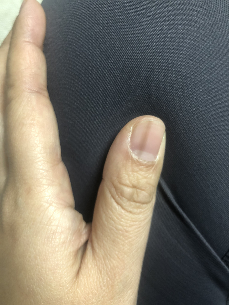 大拇指指甲有一条黑线图片