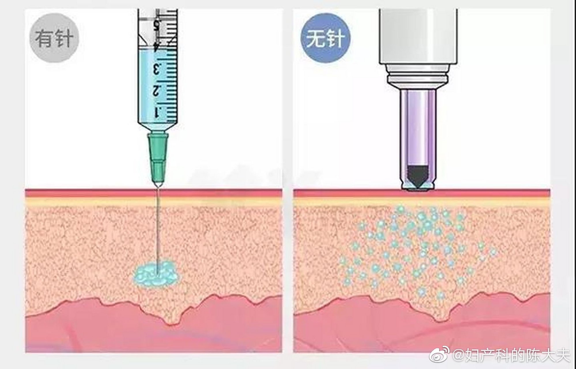 生长激素注射部位图片