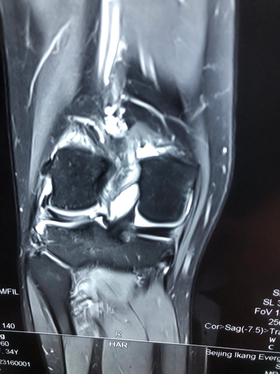 外侧盘状半月板损伤核磁表现 今天两台手术之一,外侧盘状半月板损伤