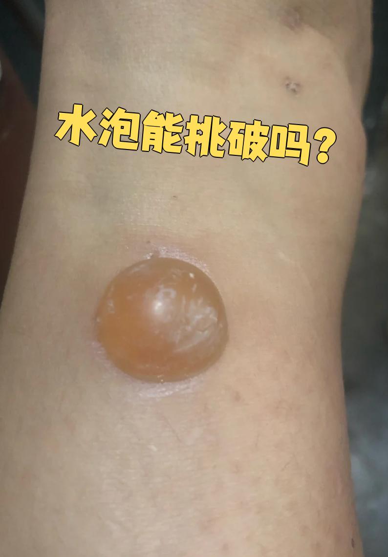 给别 水泡破了会有危险吗挑水泡水泡自然吸收好还是挑破水泡能制破吗