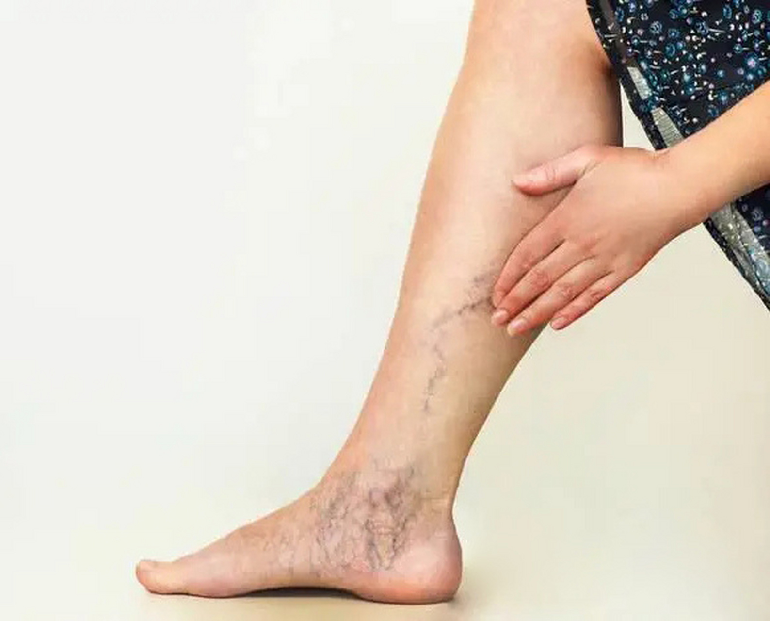 腿部红血丝是静脉曲张吗?