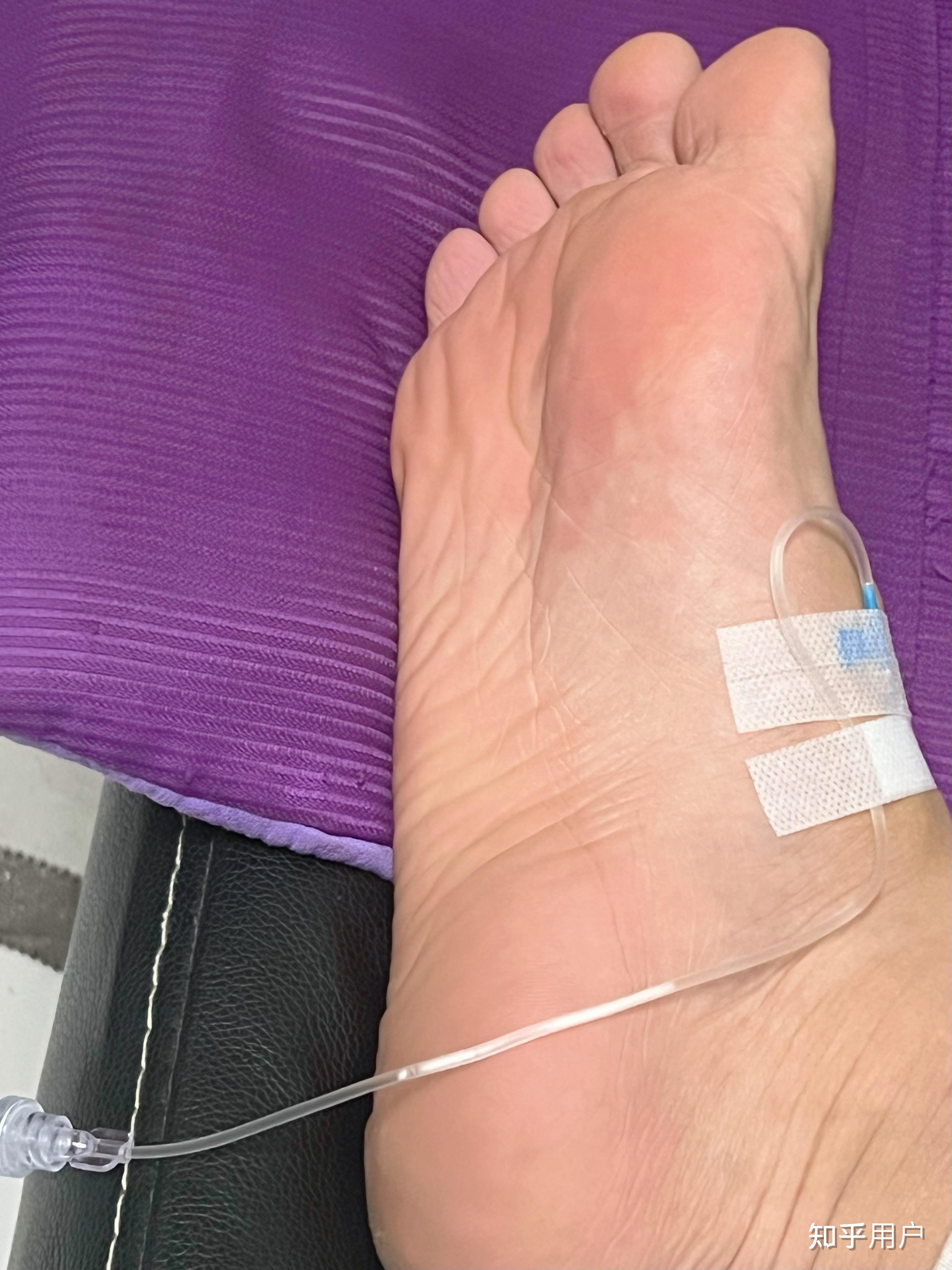 有没有在脚上打针抽血输液的经历