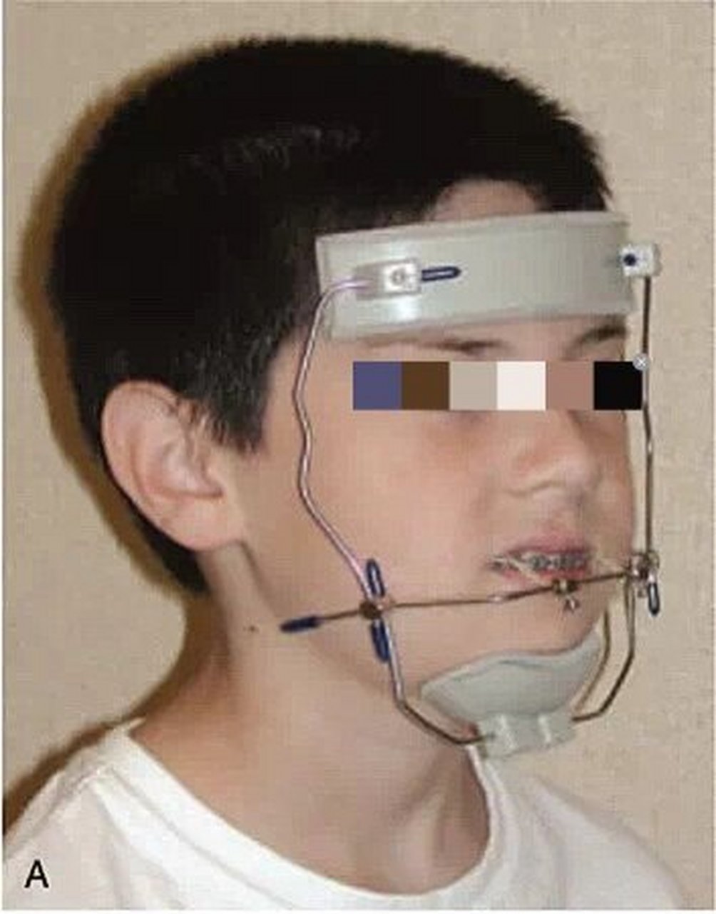 前方牵引口外部分即面具