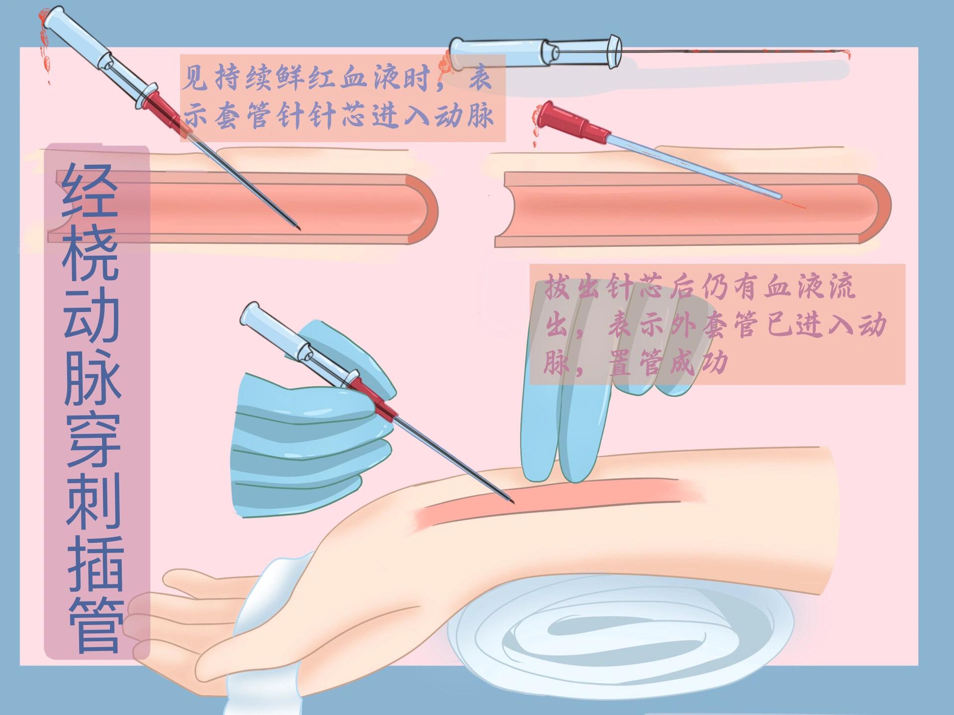 经桡动脉穿刺置管