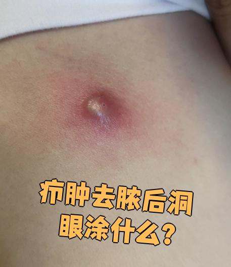 疖肿去脓后洞眼涂什么?