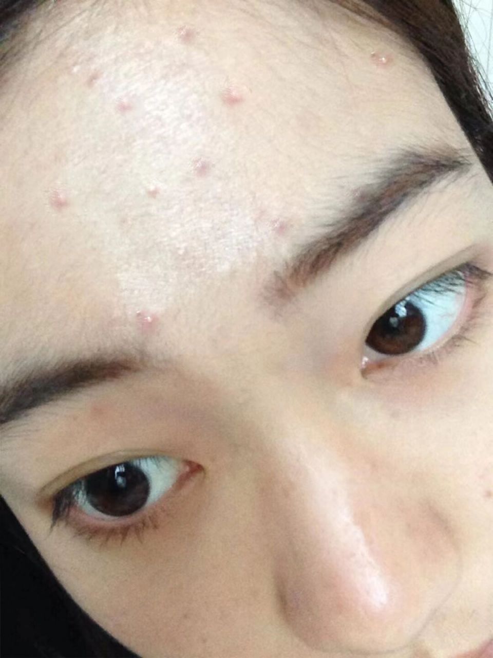 重度脂溢性皮炎的姐妹看看我!发现了一个巨牛还很便宜的方法!