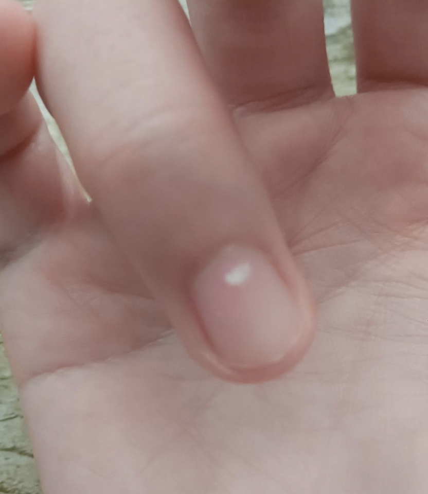 一岁宝宝手指甲上有白点是怎么回事?