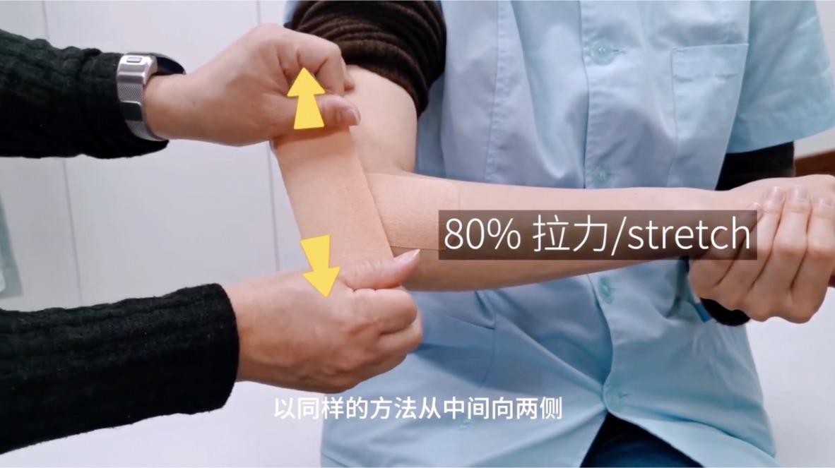 网球肘的肌内效贴贴法帮助缓解网球肘的疼痛改善手肘外侧的疼痛