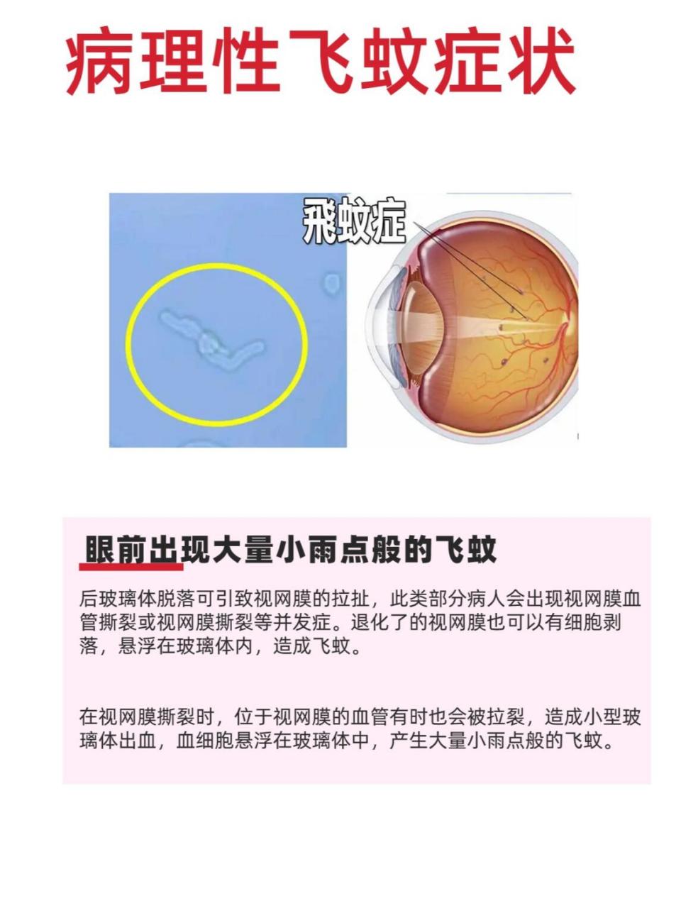 飞蚊症画面图片