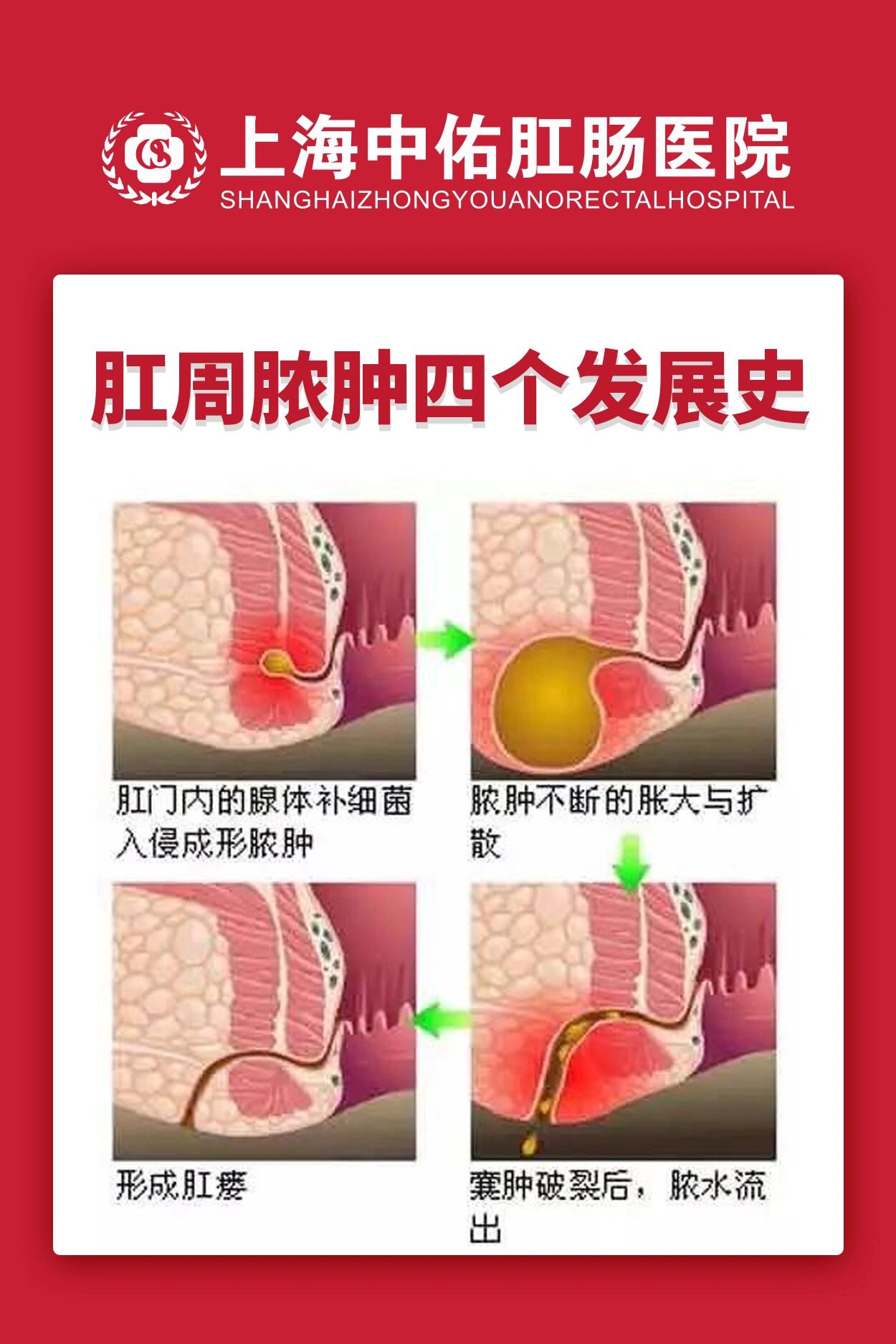 肛周脓肿需要手术吗图片