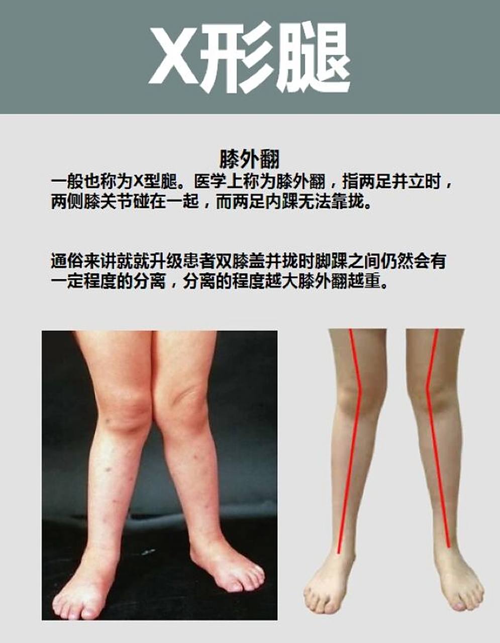 儿童常见x型腿如何矫正