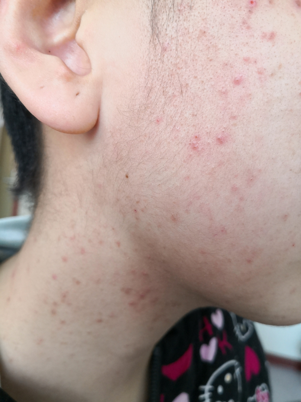 马拉色菌毛囊炎症状#毛囊炎# 前胸后背和面部都有发病.