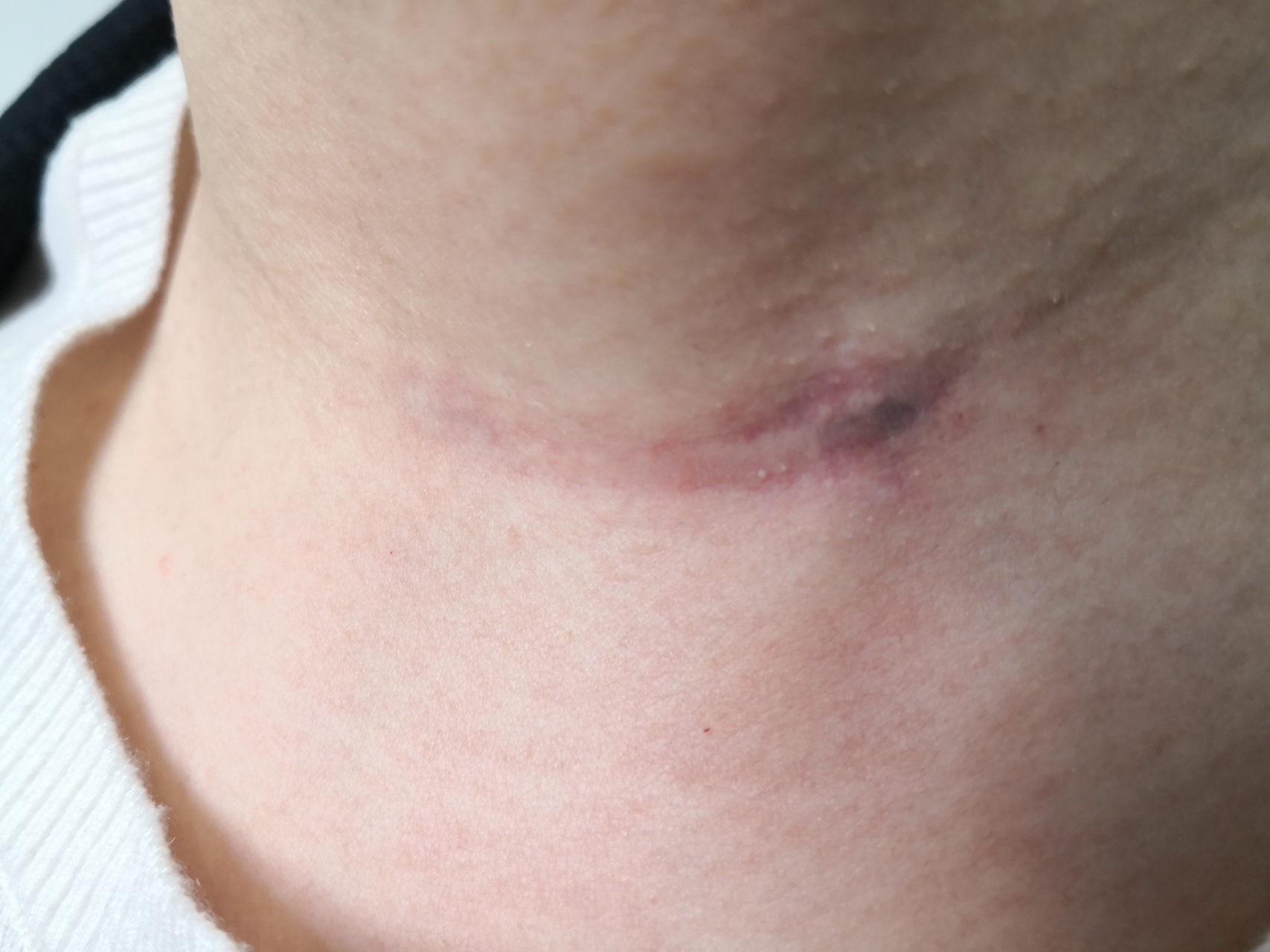 甲状腺手术切除后疤痕.激光治疗修复中.