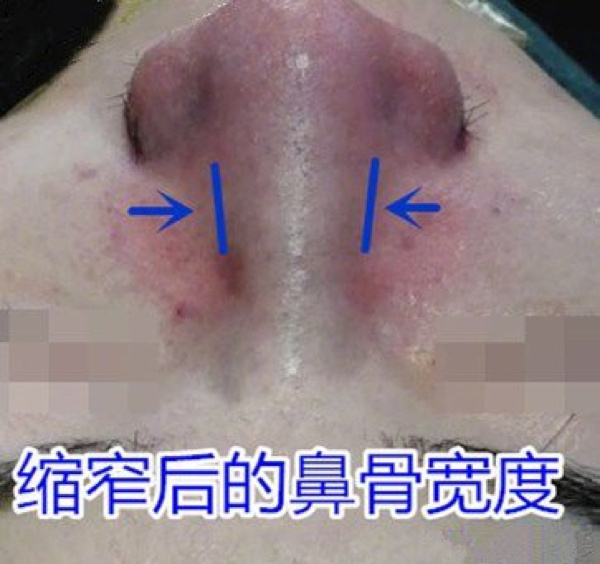 鼻骨内推原理