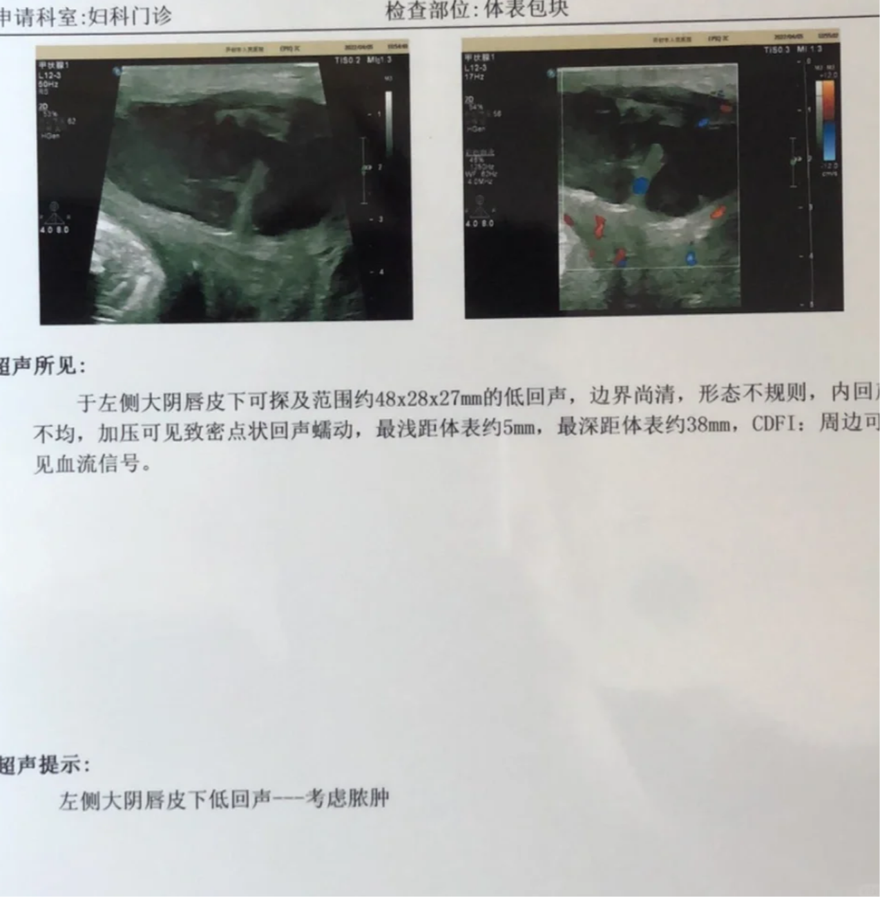 最常见的原因是外阴疖肿或者前庭大腺囊肿