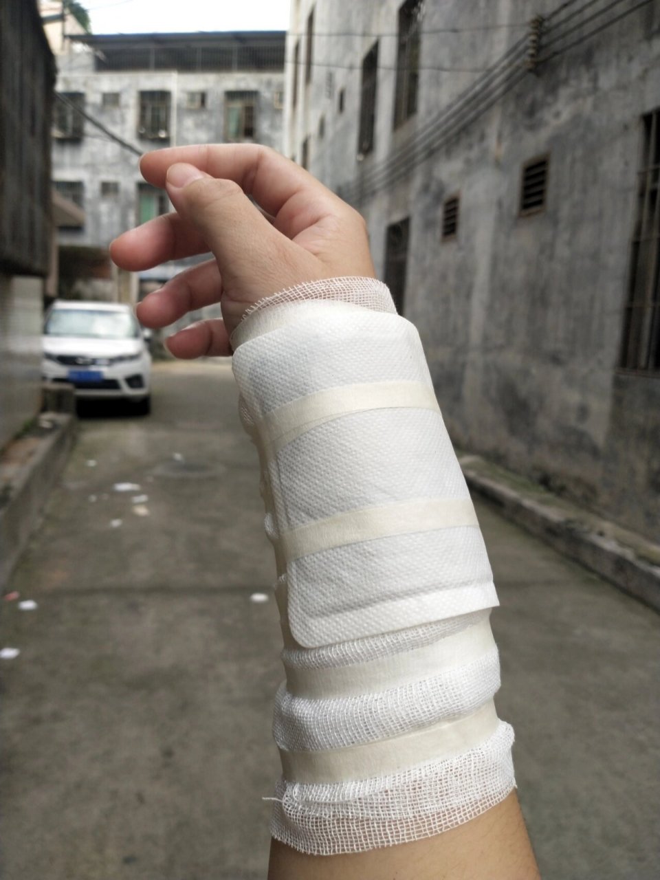 腱鞘炎,骨折式包扎😂 因为跳绳所以手腕腱消炎,我可能是史上第一人