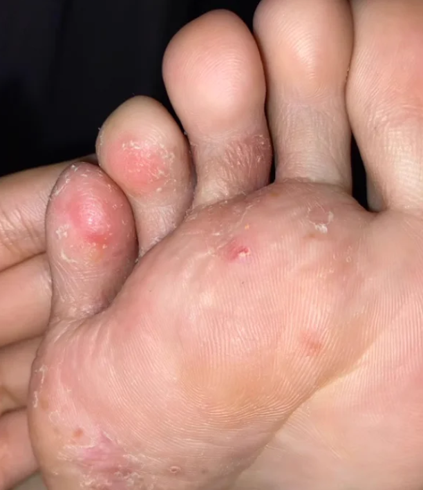 为什么脚上会有很多红点