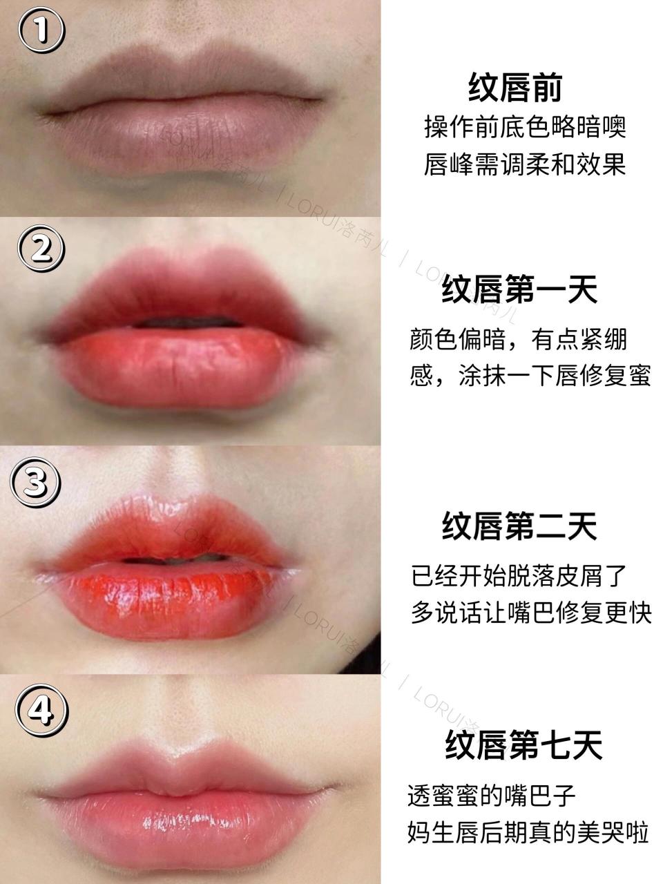 纹唇后期恢复记录实拍图1-7天 | 收藏版  ① 纹唇前 操作前底色略暗噢
