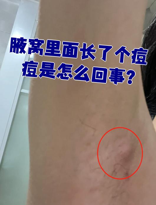 腋窝里长了个痘痘,可能是肿大的淋巴结,也可能是疖肿或毛囊炎