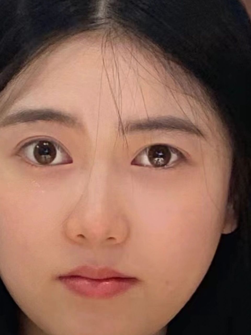 眼睛一大一小 眼睛一大一小的要怎么治疗呀 肉眼看还行,一拍照片就