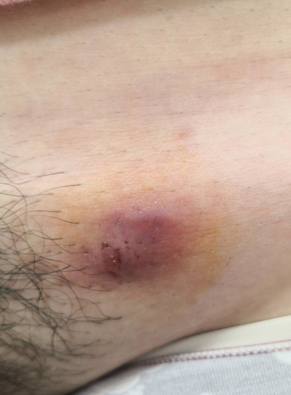 腹部疖肿症状#解决皮肤问题专注皮肤美容##皮肤